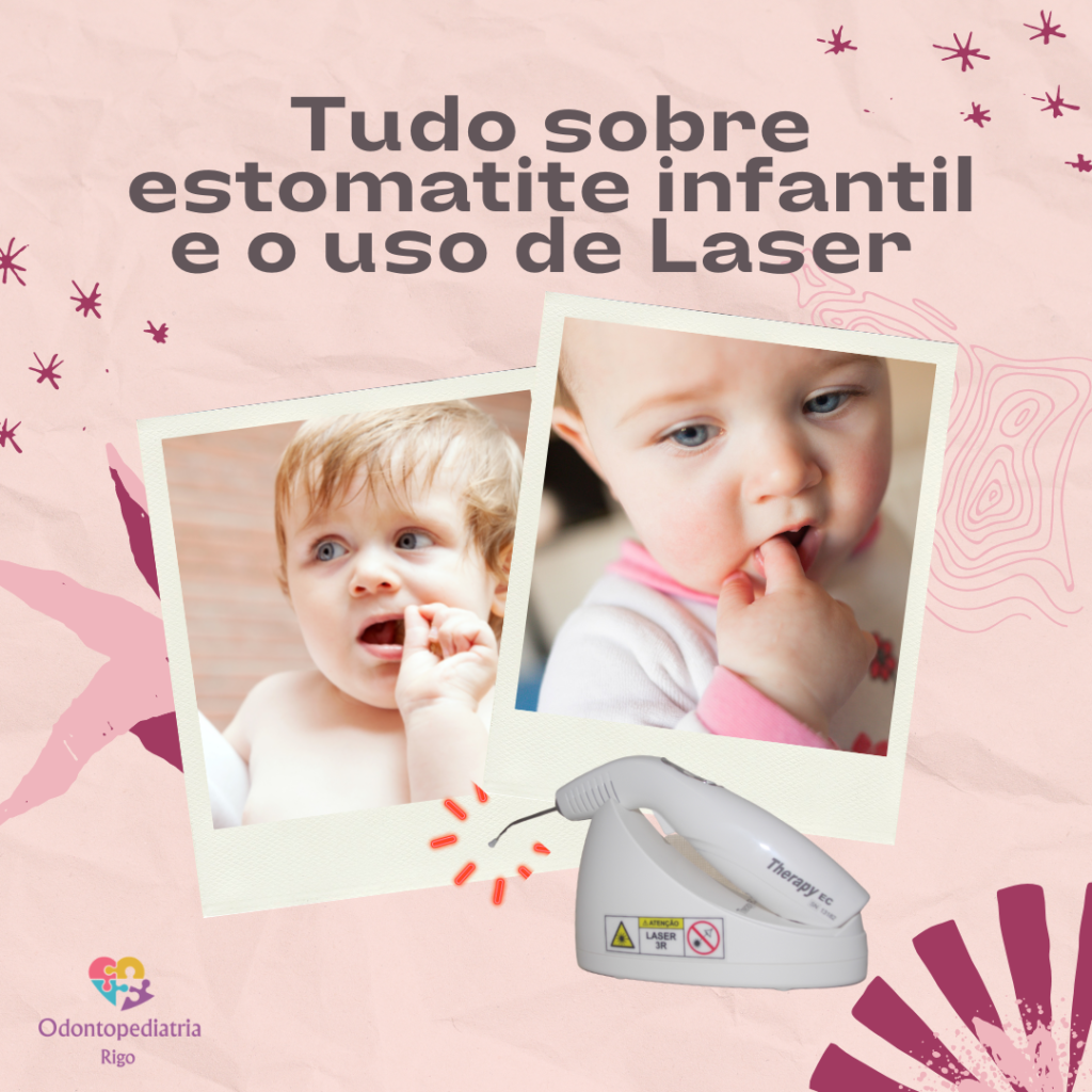 Laser e estomatite infantil